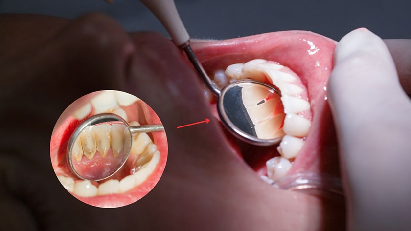 có nên lấy cao răng không