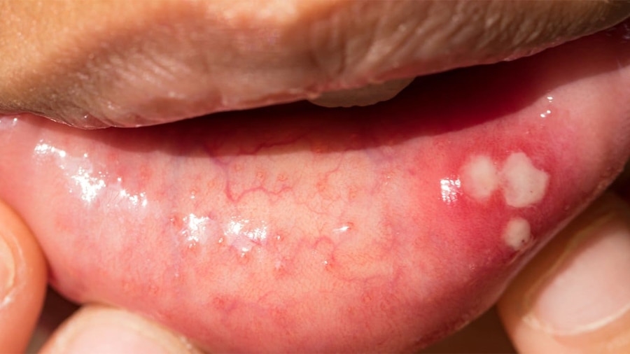 lở miệng ở môi có nguy hiểm không