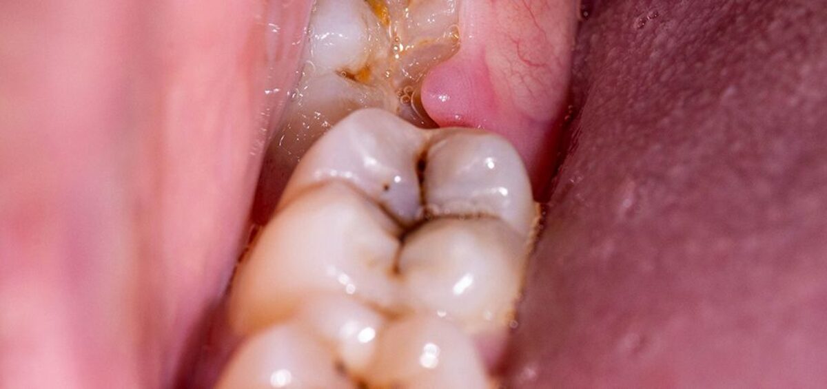 răng khôn bị sâu  - colgate