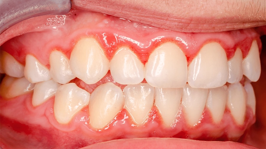 cách chữa viêm lợi