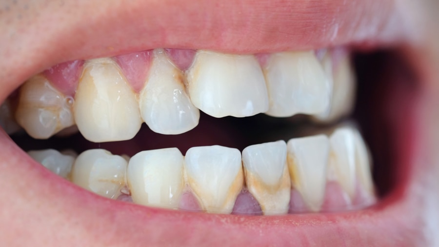 Các loại sâu răng - colgate