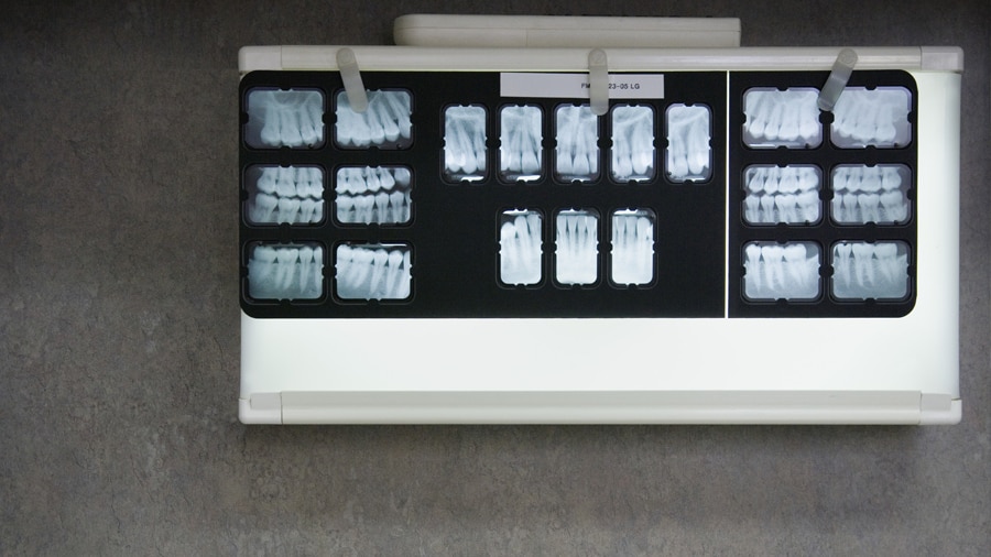 Phương pháp chụp x-quang nha khoa