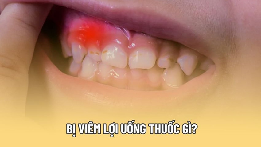 Bị viêm lợi uống thuốc gì nhanh hết bệnh?