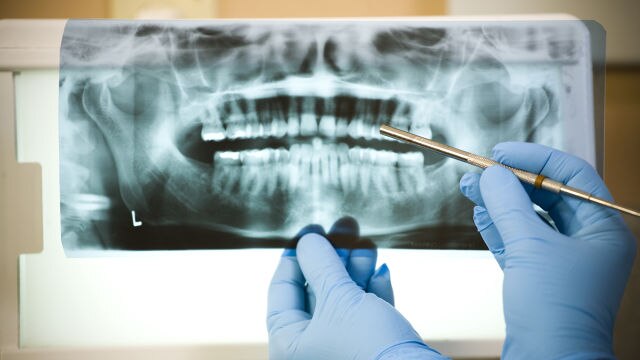 Tôi Có Cần Thực Hiện Lấy Tủy Răng Không?