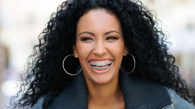  Chi Phí Của Niềng Răng Bằng Invisalign So Với Niềng Răng Truyền Thống