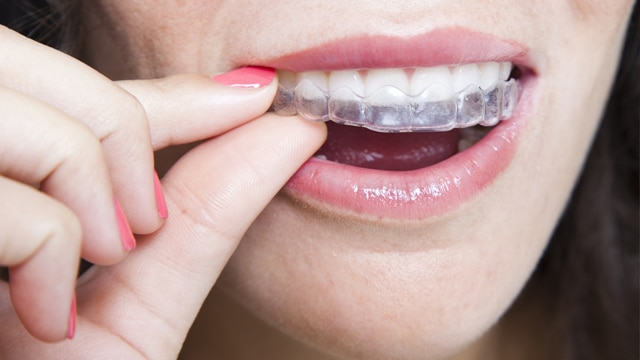 Làm Sao Để Biết Niềng Răng Damon Là Một Lựa Chọn Tối Ưu Dành Cho Tôi?