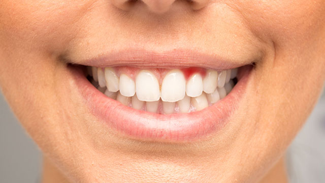 Viêm nướu răng: dấu hiệu, nguyên nhân và cách điều trị
