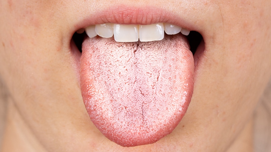 Bệnh nấm lưỡi ở người lớn