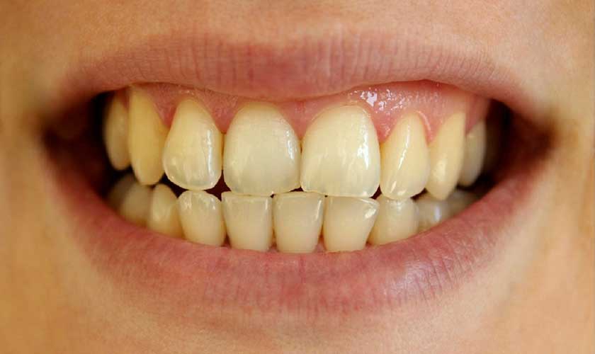 Răng ố vàng: nguyên nhân và cách khắc phục hiệu quả tại nhà