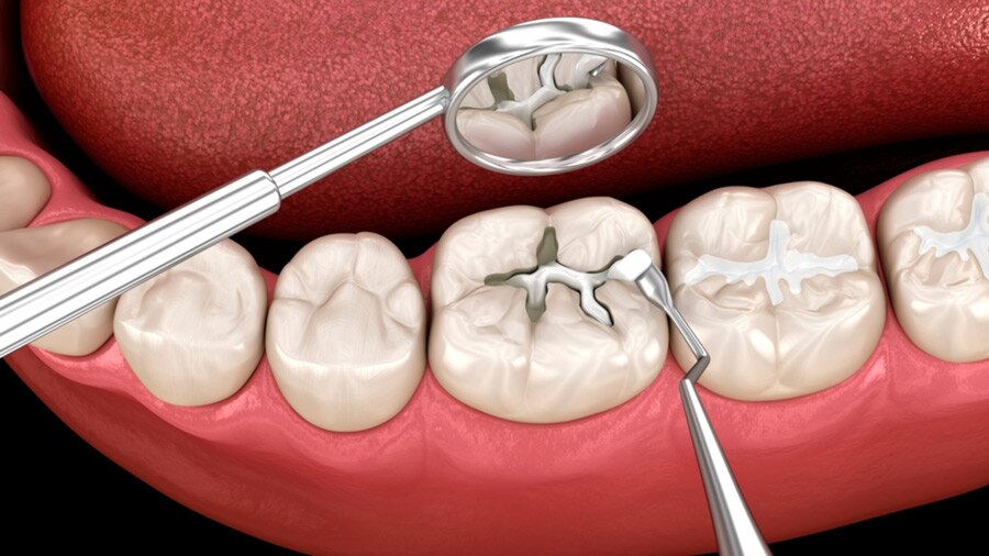 Trám răng là gì? Khi nào cần trám? Quy trình như thế nào và vật liệu ra sao?