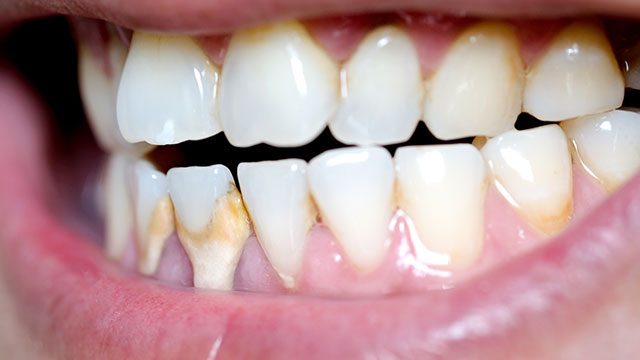 Mảng bám là gì? Cách lấy mảng bám trên răng