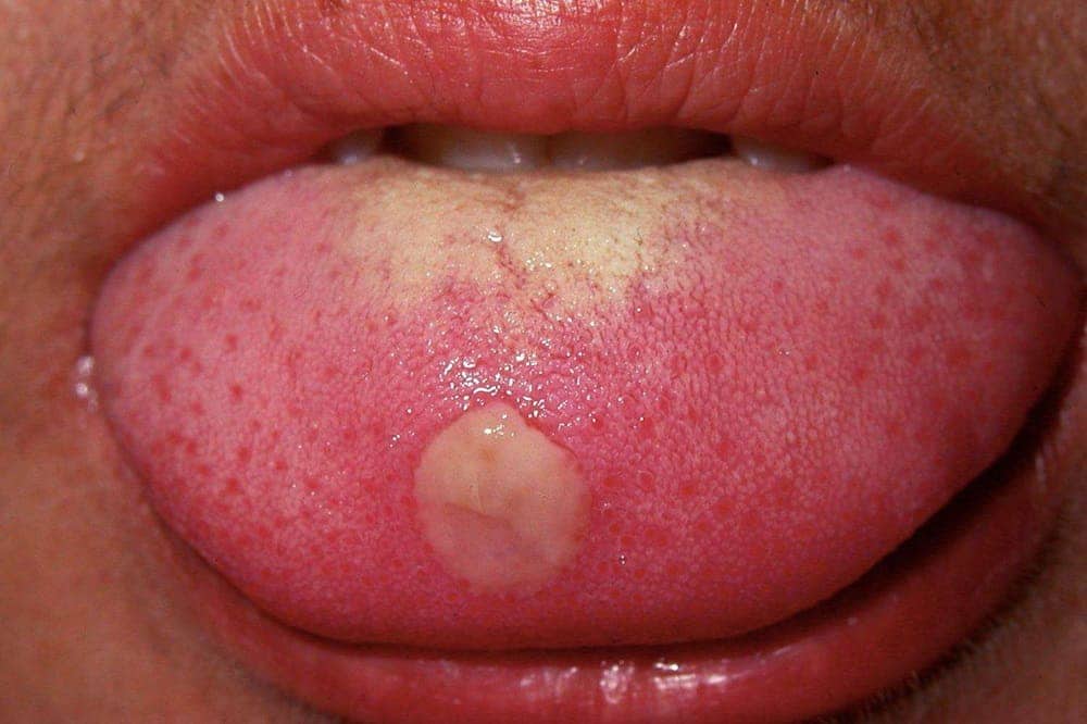 Viêm lưỡi dẫn đến sưng viêm