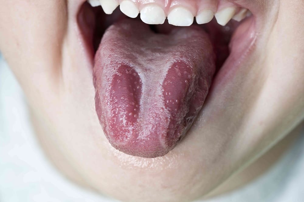 Viêm lưỡi bản đồ xuất hiện từng vệt màu đỏ, trắng đan xen