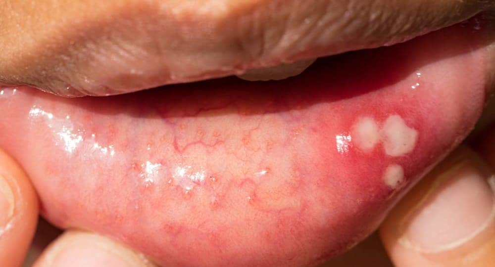 Loét miệng dẫn đến viêm lưỡi