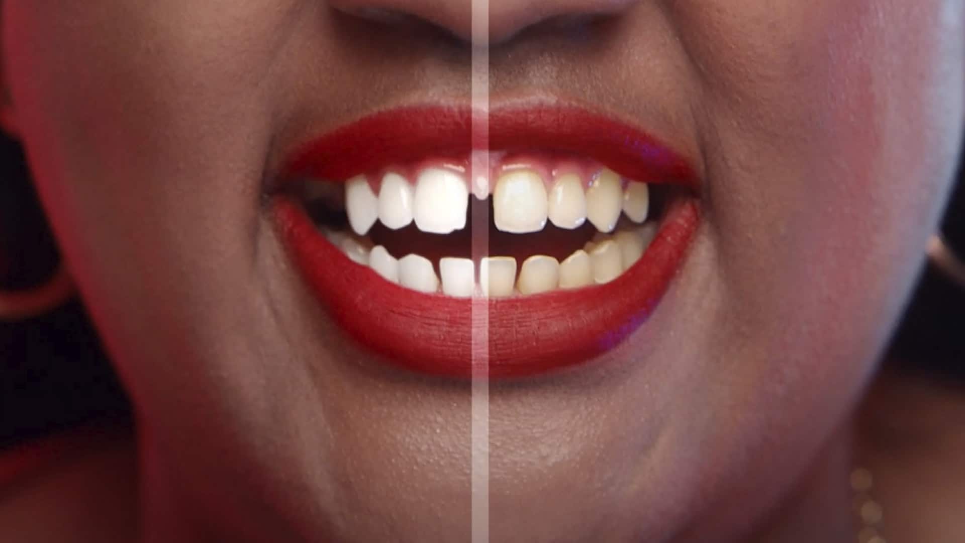 Bức ảnh của Suzie trước và sau khi sử dụng sản phẩm làm trắng răng từ Colgate