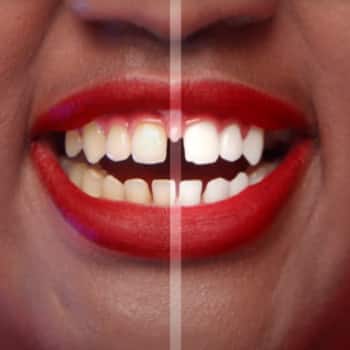 mỉm cười trước và sau khi sử dụng Kem đánh răng Colgate® Optic White O2