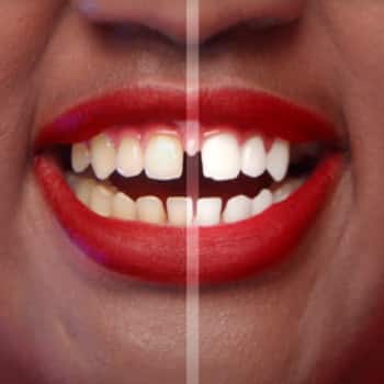 mỉm cười trước và sau khi sử dụng Kem đánh răng Colgate® Optic White O2 mỉm cười trước và sau khi sử dụng Kem đánh răng Colgate® Optic White O2