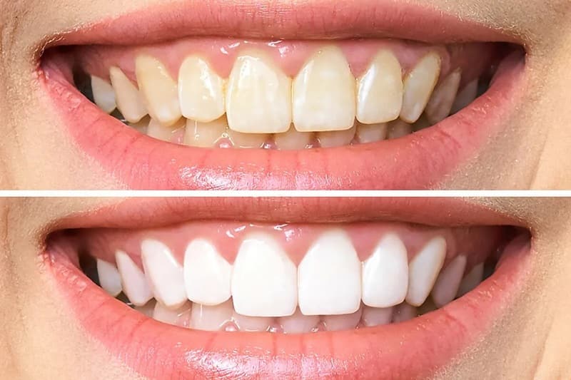 người bị xỉn màu răng có thể sử dụng gel làm trắng răng