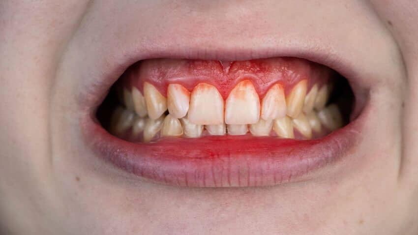 Thường xuyên đánh răng bị chảy máu có thể gây ra hậu quả tiềm ẩn đáng lo ngại