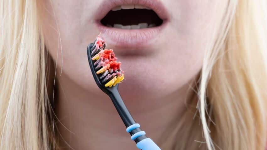 Viêm nướu là nguyên nhân chính gây chảy máu chân răng