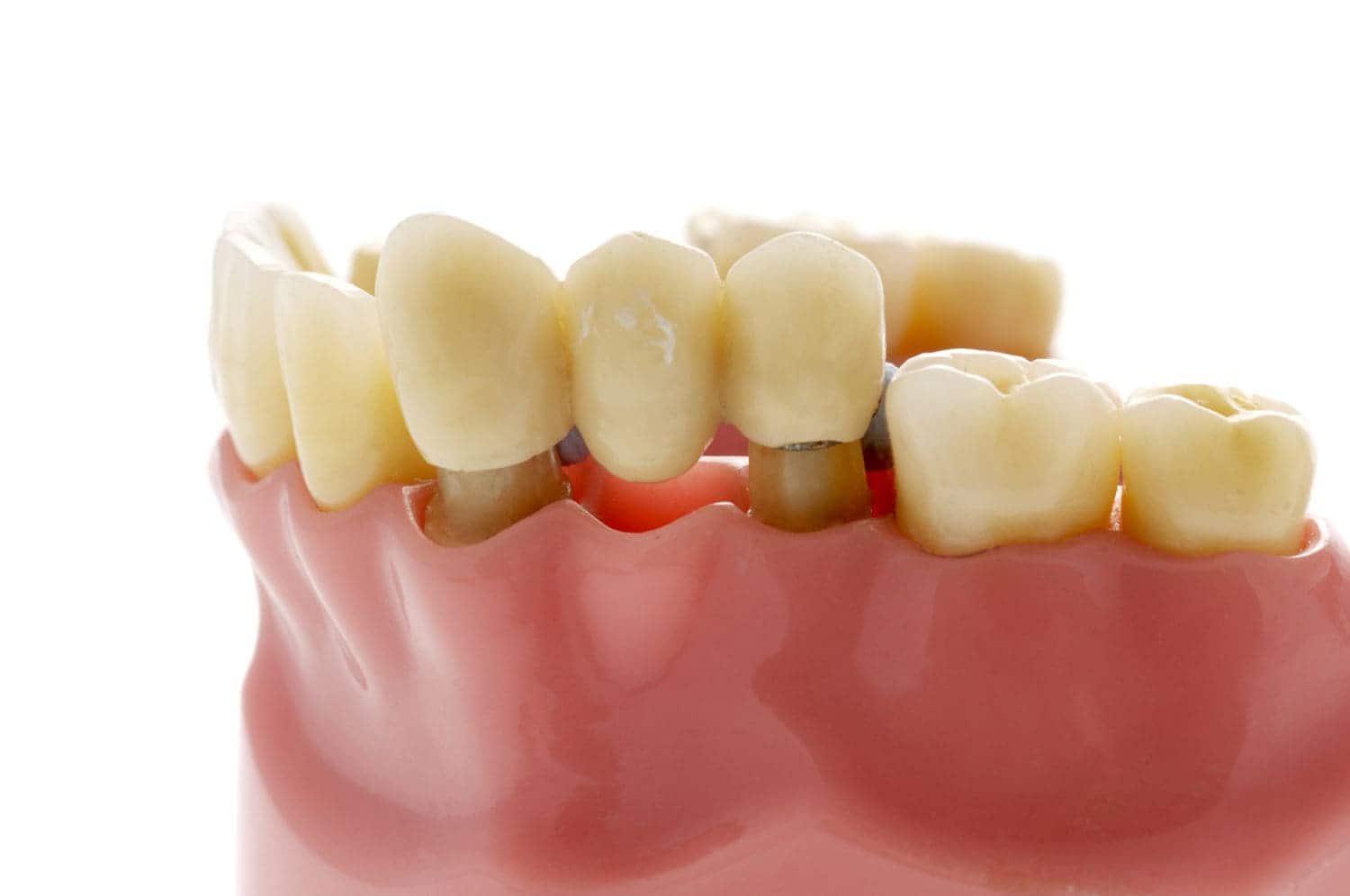 Cầu răng sứ, ưu và nhược điểm
