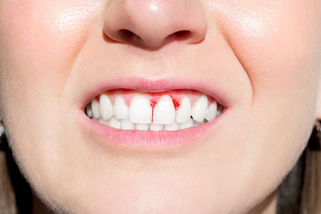 Chảy máu chân răng là bệnh lý răng miệng thường gặp với tình trạng chảy máu quanh nướu và chân răng