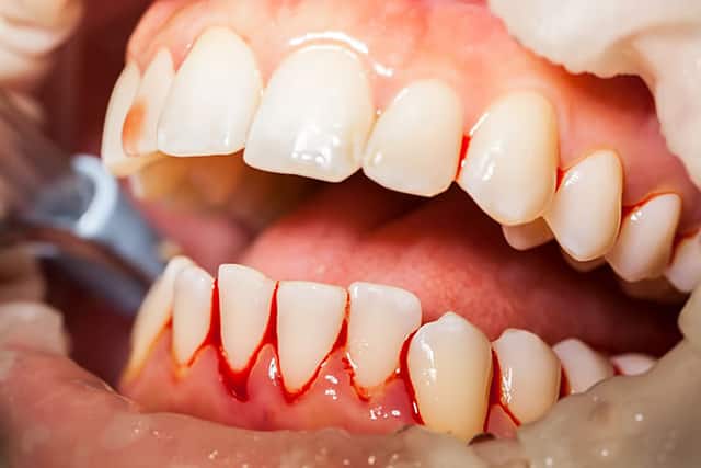 Chảy máu chân răng là dấu hiệu của nhiều bệnh lý răng miệng nghiêm trọng
