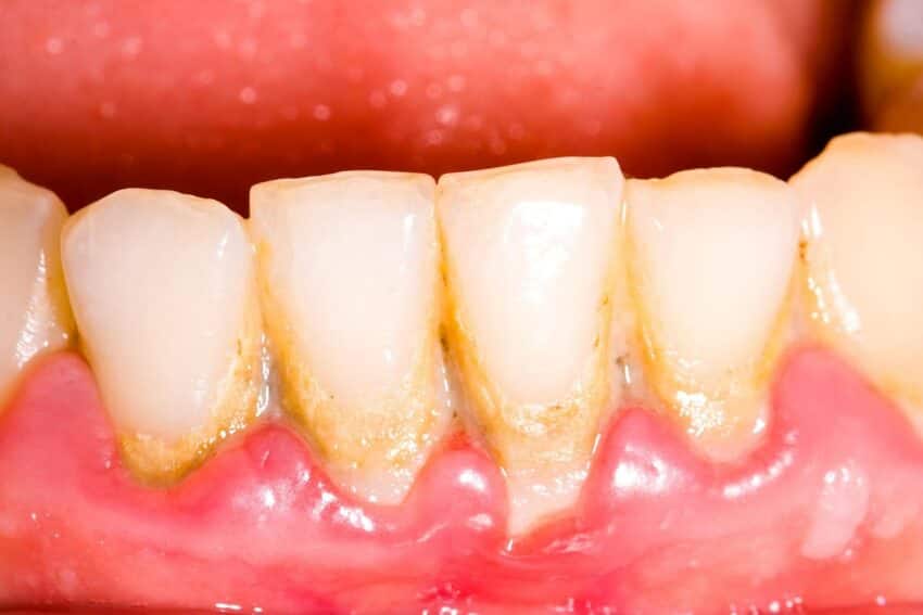 Mảng bám trên răng là mảng trơn nhầy chứa vi khuẩn và thức ăn thừa