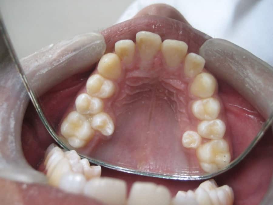 Người trưởng thành có bao nhiêu cái răng? Răng dư là răng mọc thêm có thể xảy ra ở bất kì vị trí nào trong hàm