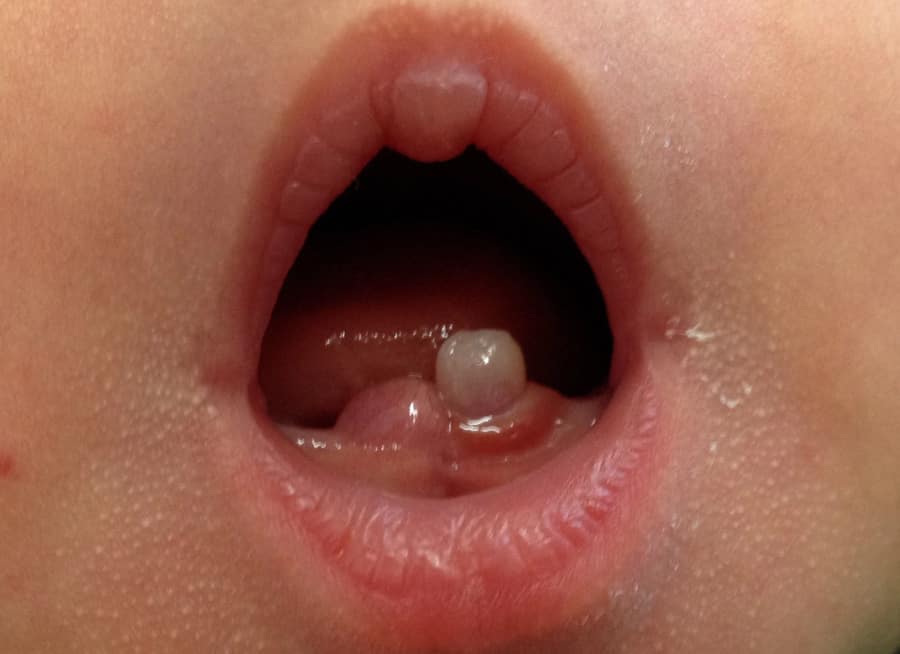 Trẻ mọc răng sơ sinh ngay sau khi bé chào đời