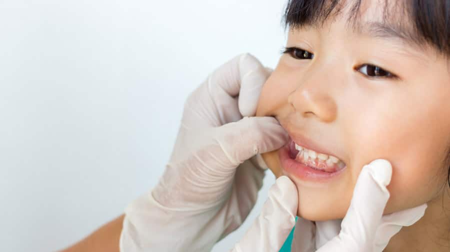 Nguyên nhân sâu răng ở trẻ nhỏ - colgate
