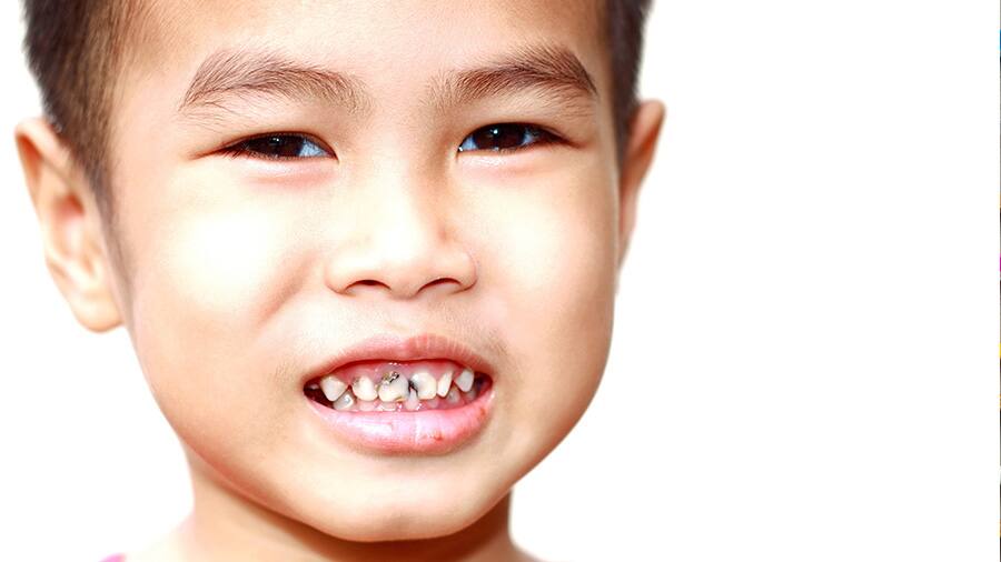 Cách phòng ngừa sâu răng ở trẻ em