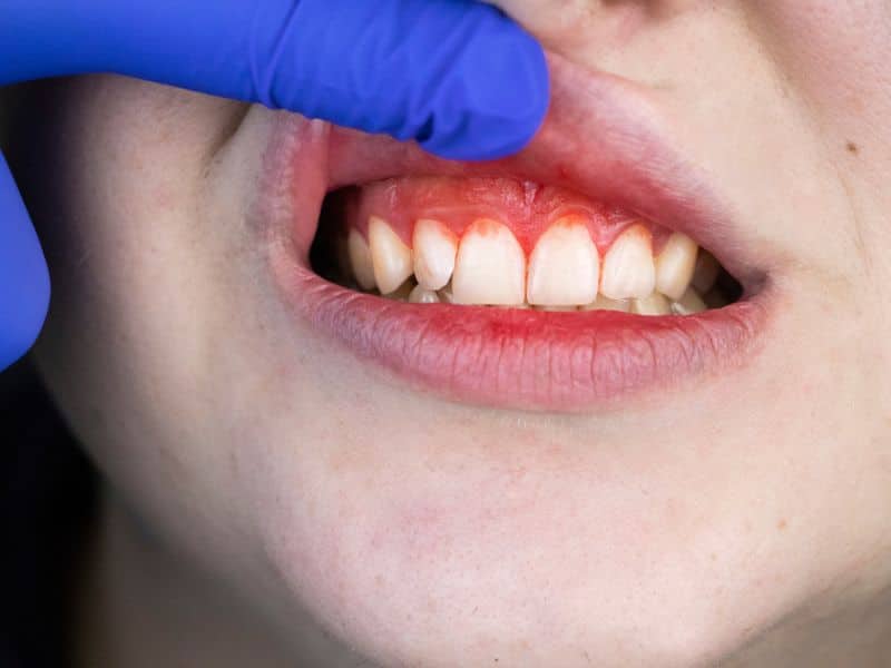 Viêm nướu là nguyên nhân chính gây chảy máu chân răng khi đánh răng