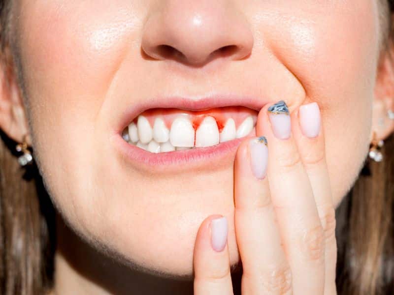 Chảy máu chân răng là tình trạng chảy máu từ nướu và khe răng
