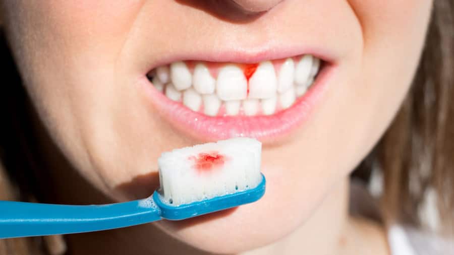 Cách trị chảy máu chăn răng