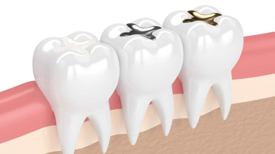Hàn răng sâu là gì? Quy trình thực hiện và các lưu ý cần biết