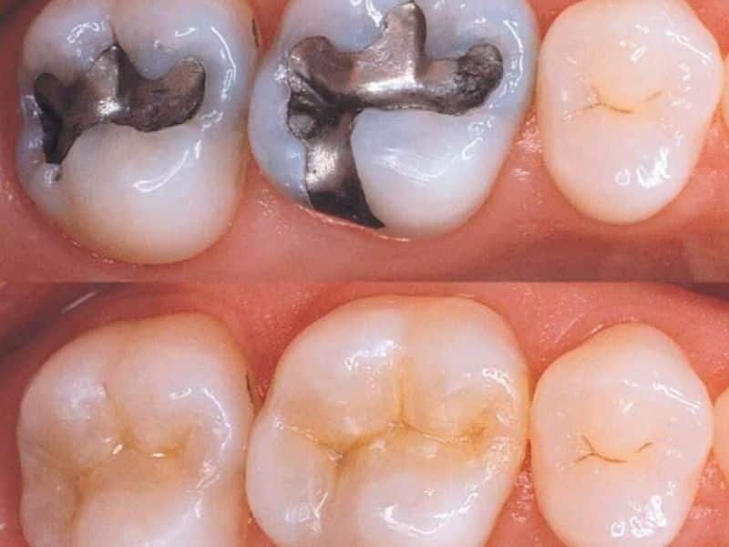 Tiến hành hàn răng sâu ngay khi phát hiện lỗ sâu càng sớm càng tốt