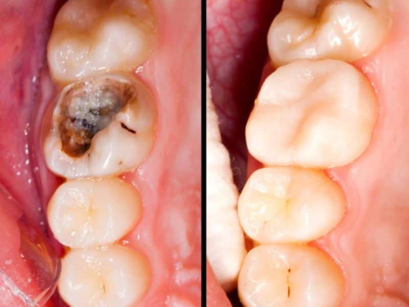 Răng sâu có hàn được hay không tùy vào mức độ sâu răng