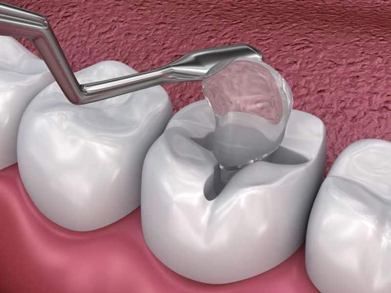 Kỹ thuật hàn răng để lấp đầy mô răng khuyết thiếu do sâu