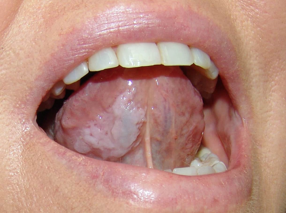 Nguyên nhân và cách điều trị bệnh bạch sản niêm
