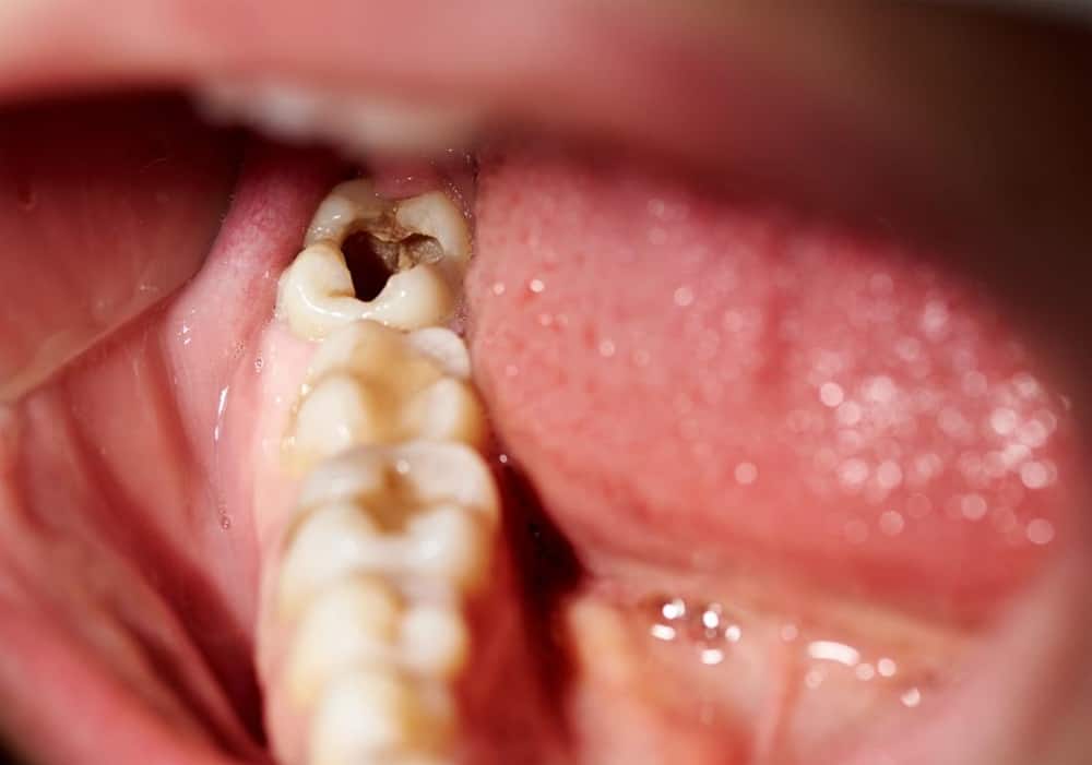 Răng khôn bị sâu sẽ xuất hiện các đốm nâu đen