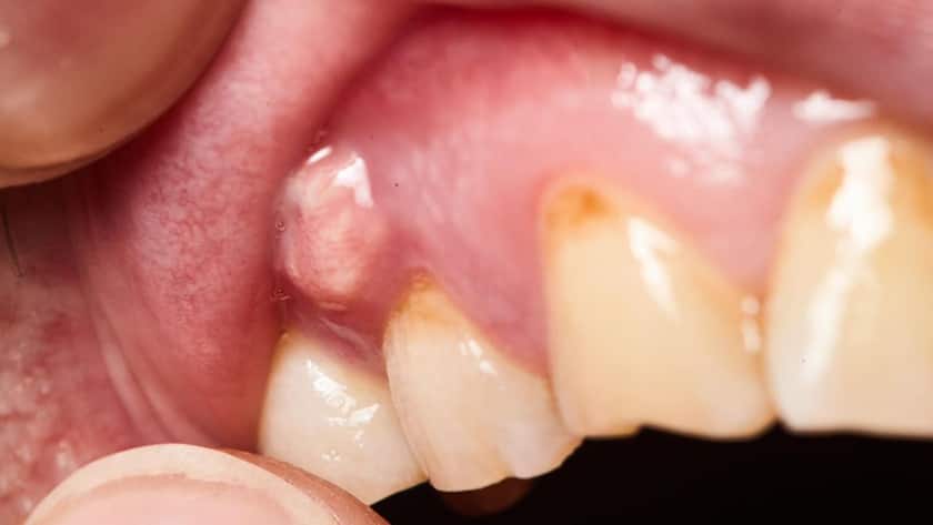 Nhiễm trùng vùng nướu và dấu hiệu nhiễm trùng sau khi nhổ răng khôn