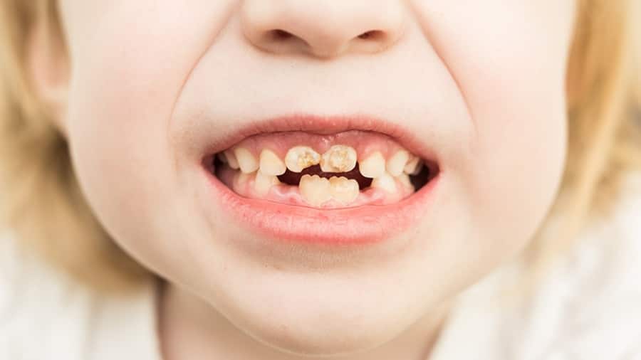 Nguyên nhân sâu răng trẻ em và cách ngăn ngừa