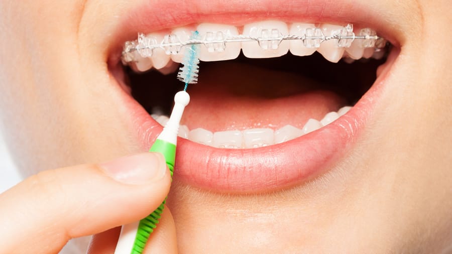 Cách chọn bàn chải cho răng niềng - colgate