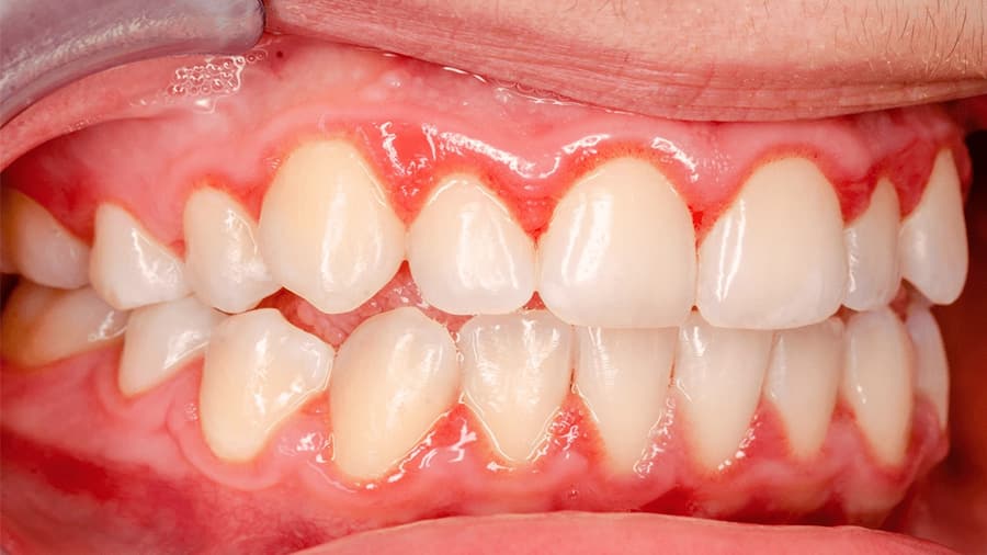 cách chữa viêm lợi