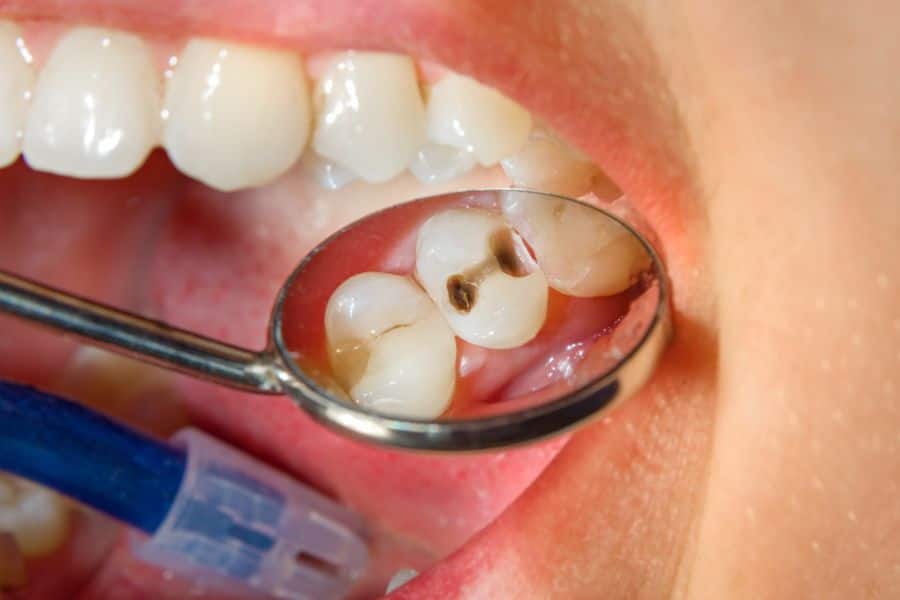 Sâu răng là các lỗ hổng có màu đen trên bề mặt răng