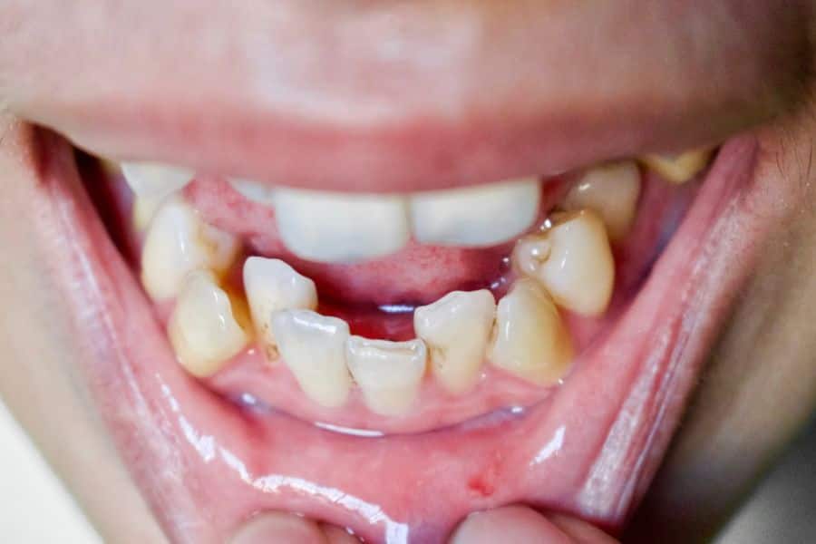 Sâu răng kéo dài sẽ dẫn đến tình trạng xô lệch răng