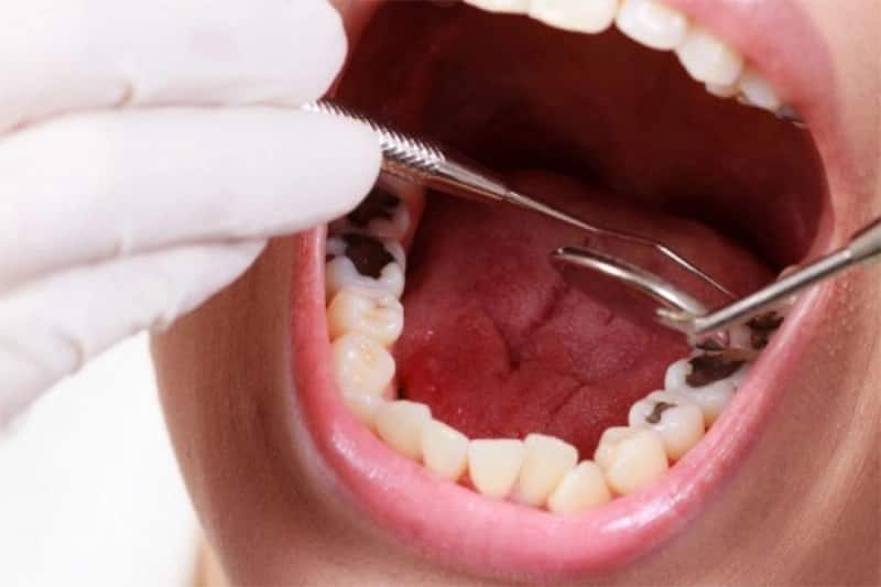 Cách trị sâu răng vĩnh viễn bằng cách trám răng, nhổ răng hoặc lấy tủy răng