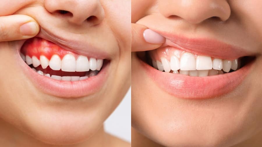 cách chữa viêm lợi - colgate