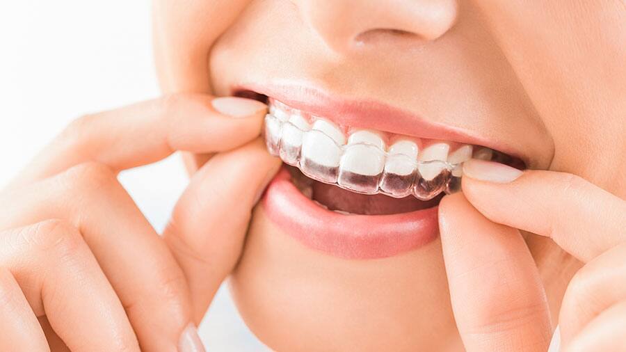 Làm trắng răng tại nhà hiệu quả